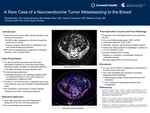 A Rare Case of a Neuroendocrine Tumor Metastasizing to the Breast