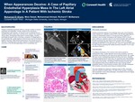When Appearances Deceive: A Case of Papillary Endothelial Hyperplasia Mass in the Left Atrial Appendage in a Patient with Ischemic Stroke