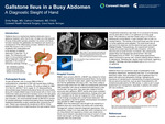 A Diagnostic Sleight of Hand: Gallstone Ileus in a Busy Abdomen