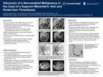 Discovery of a Sarcomatoid Malignancy in the Case of a Superior Mesenteric Vein and Portal Vein Thrombosis