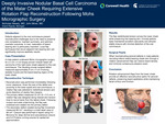 Peri-oral Reconstruction Following Mohs Surgery: An Aesthetic Consideration with Hair-bearing Skin