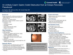 An Unlikely Culprit: Gastric Outlet Obstruction from an Ectopic Pancreatic Pseudocyst