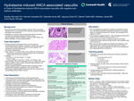 A Case of Hydralazine Induced ANCA-Associated Vasculitis with Negative Anti-histone Antibodies