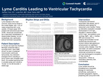 Lyme Carditis Leading to Ventricular Tachycardia