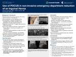 Use of Point of Care Ultrasound (POCUS) in Non-Invasive Emergency Department Reduction of an Inguinal Hernia