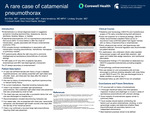 A Rare Case of Catamenial Pneumothorax