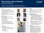 The Curious Case of Ainhum Dactolysis Spontanea by Jesse Miller, Michele Bertele-Semma, and Randy Semma
