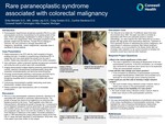 Rare Paraneoplastic Syndrome Associated with Colorectal Malignancy